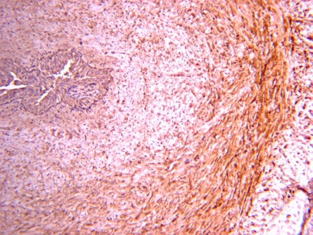 Anti-Procollagen Type III PIIINP Antibody